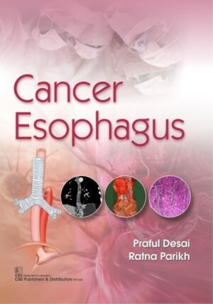 Cancer Esophagus
