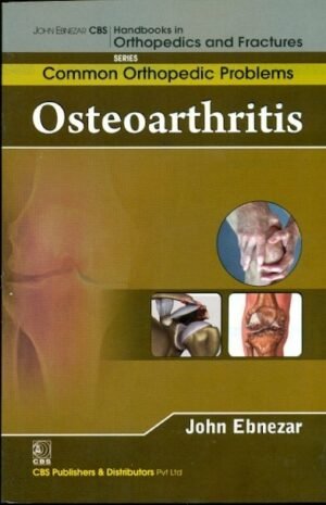 Osteoarthritis (Handbooks In Orthopedics And Fractures Series, Vol. 87 -Common Orthopedic Problems)