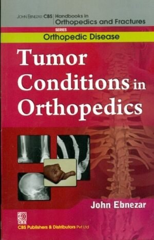 Tumor Conditions In Orthopedics (Handbooks In Orthopedics And Fractures Series, Vol. 36: Orthopedic Disease)
